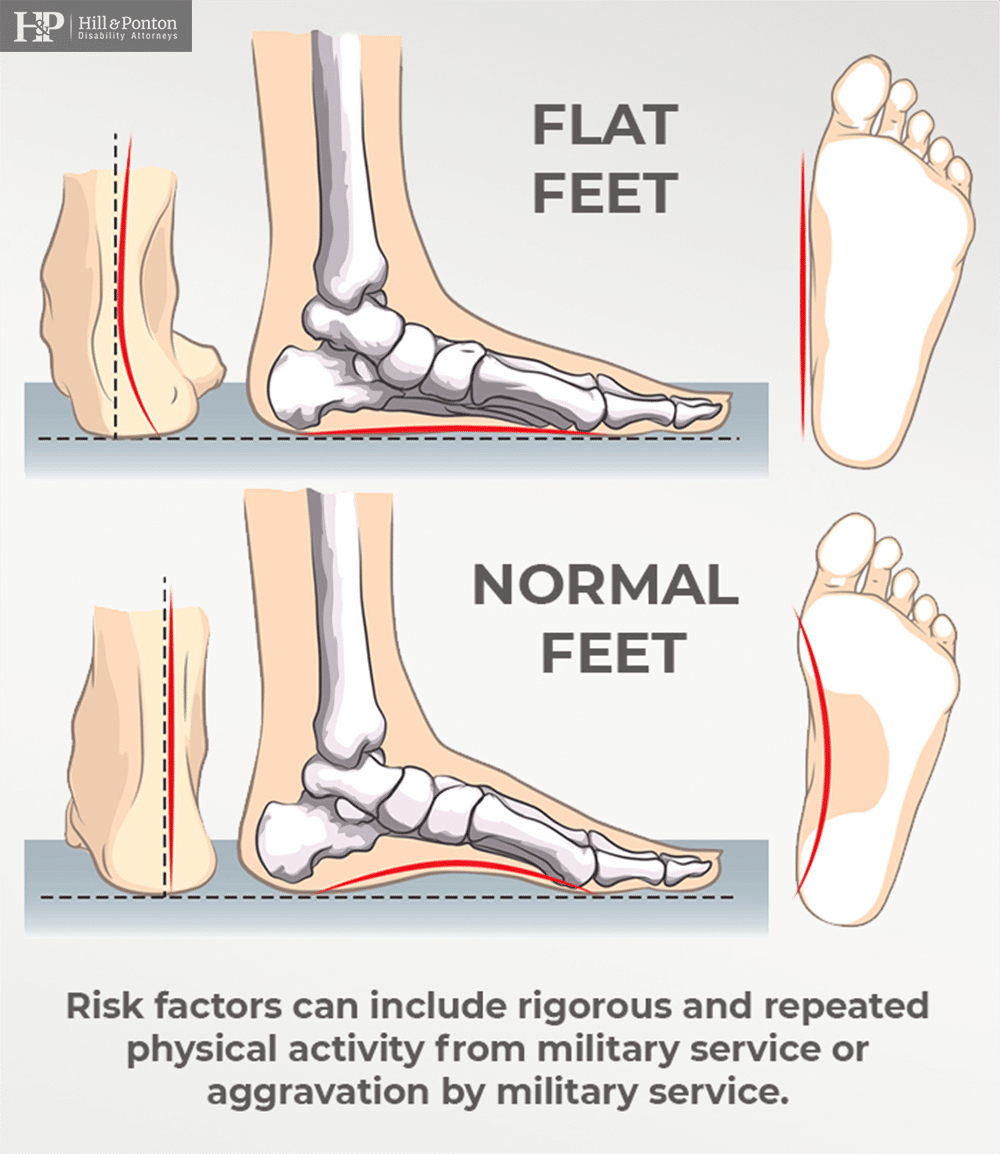 can you join the military if you have flat feet everything you need to know