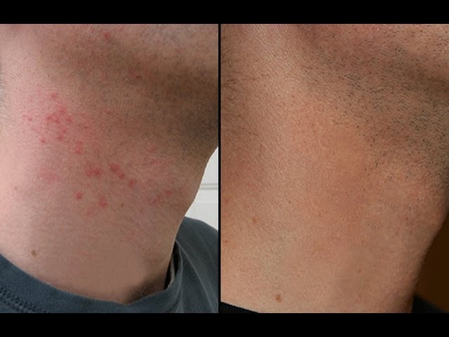 how to cure razor bumps on neck effective tips and remedies