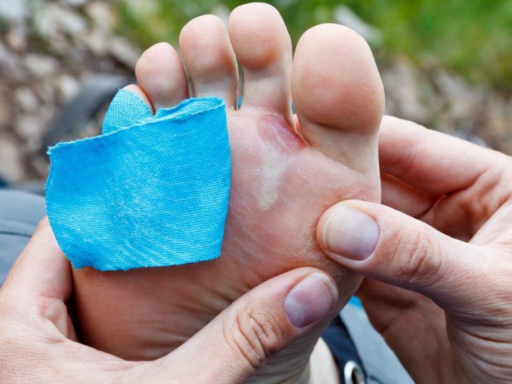 should i pop blisters on my feet essential guide to safe treatment
