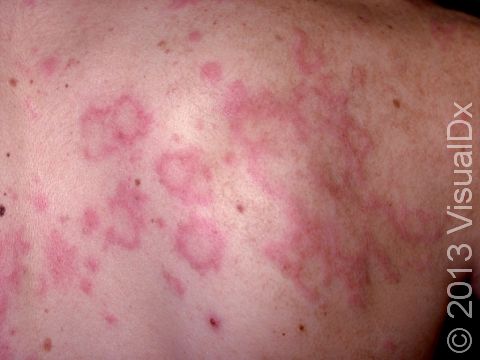 stunning photos of skin rash from mold exposure identify symptoms treatment
